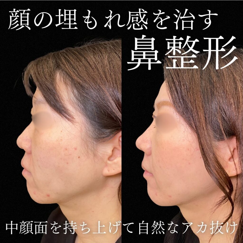 鼻尖形成クローズ法と耳軟骨移植と鼻プロテーゼと小鼻縮小と猫貴族と人工真皮と人中短縮術と糸リフトの症例写真