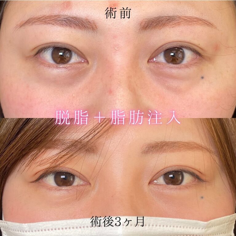 eクリニック名古屋院の経結膜脱脂の症例写真（5）