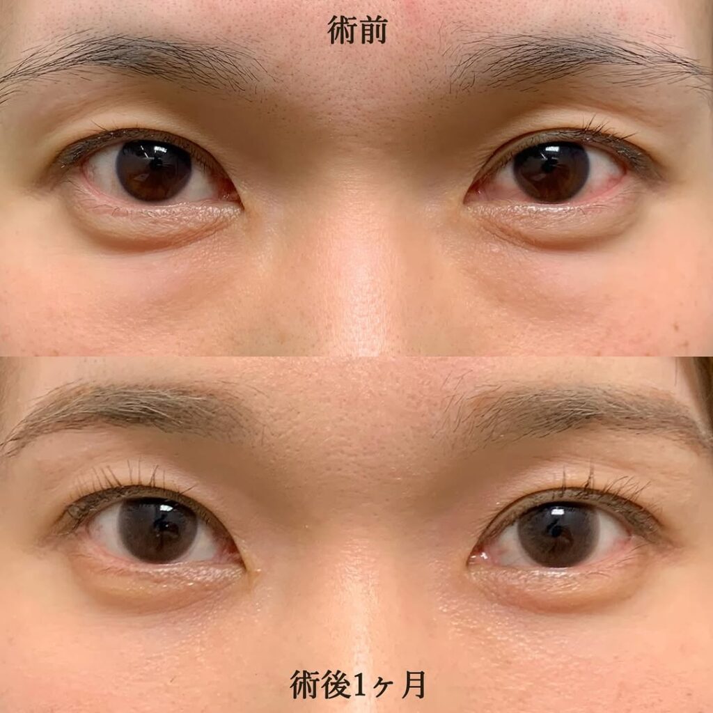 eクリニック名古屋院の経結膜脱脂＋脂肪注入