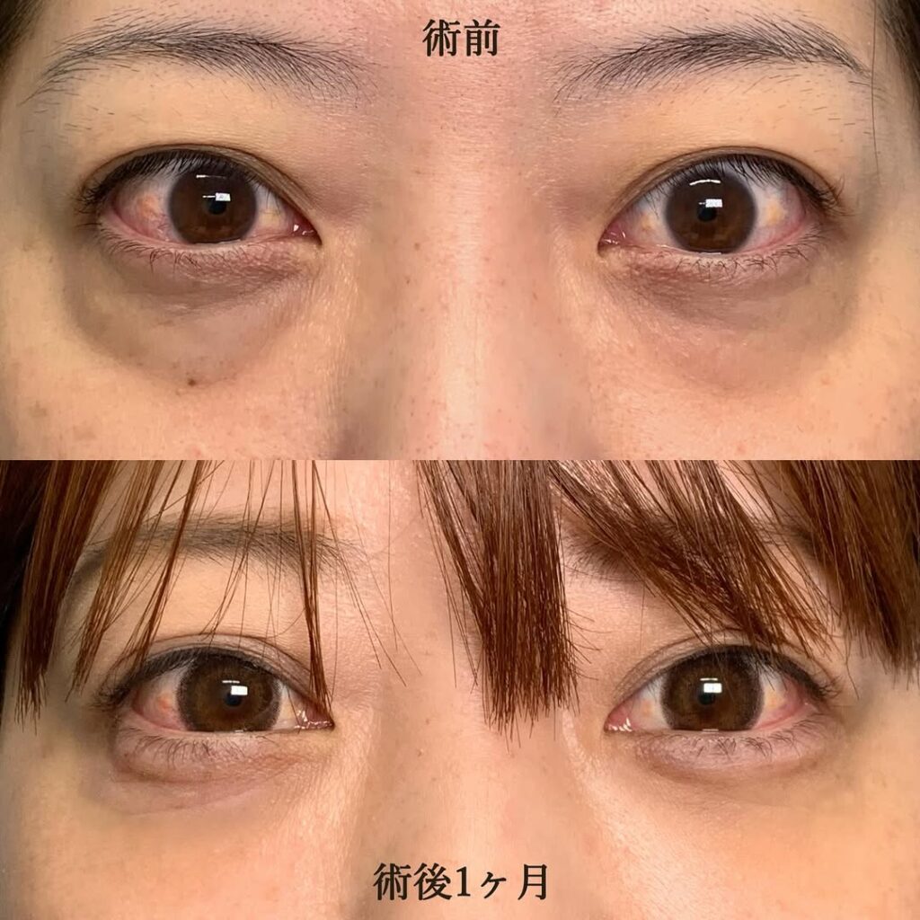 eクリニック名古屋院の経結膜脱脂＋脂肪注入