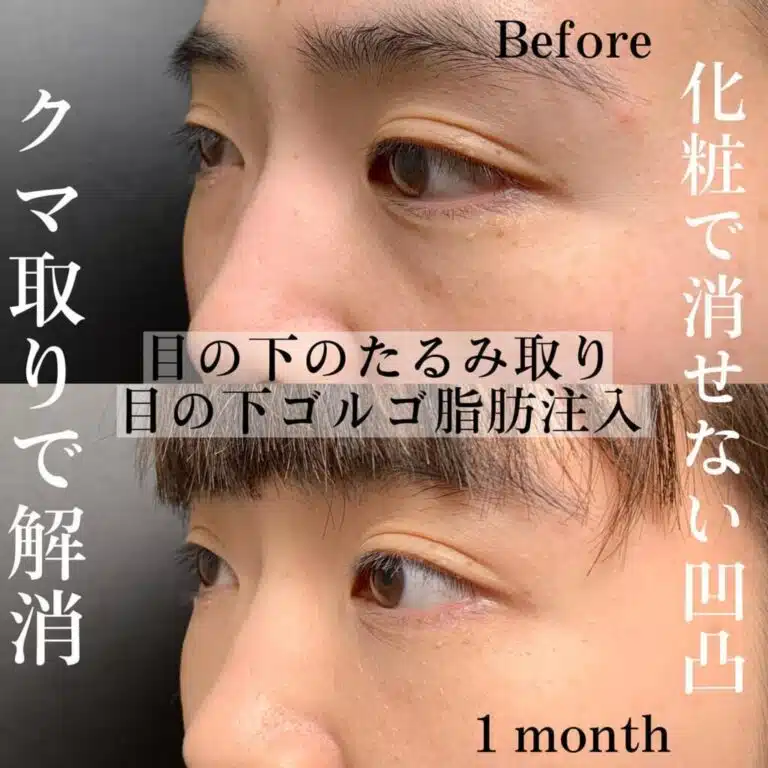 脂肪注入