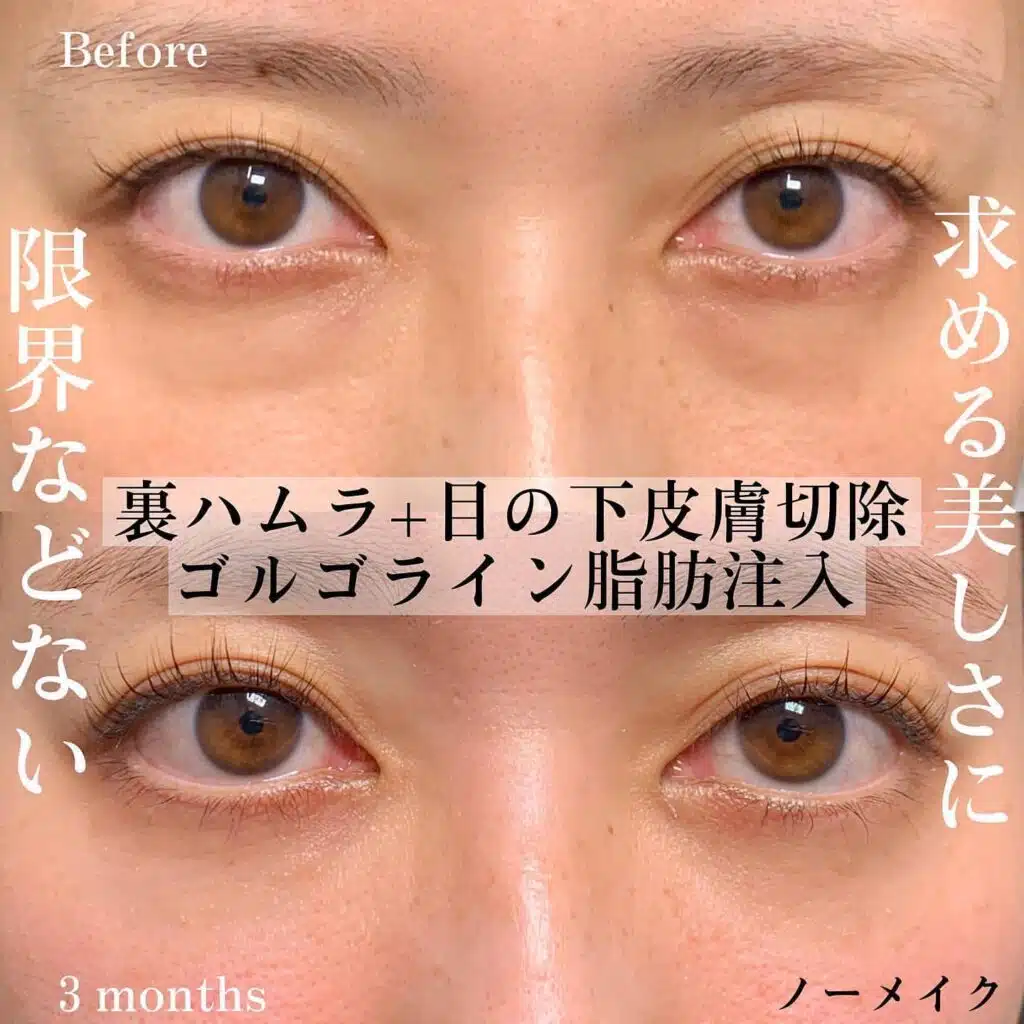 裏ハムラ 皮膚切除