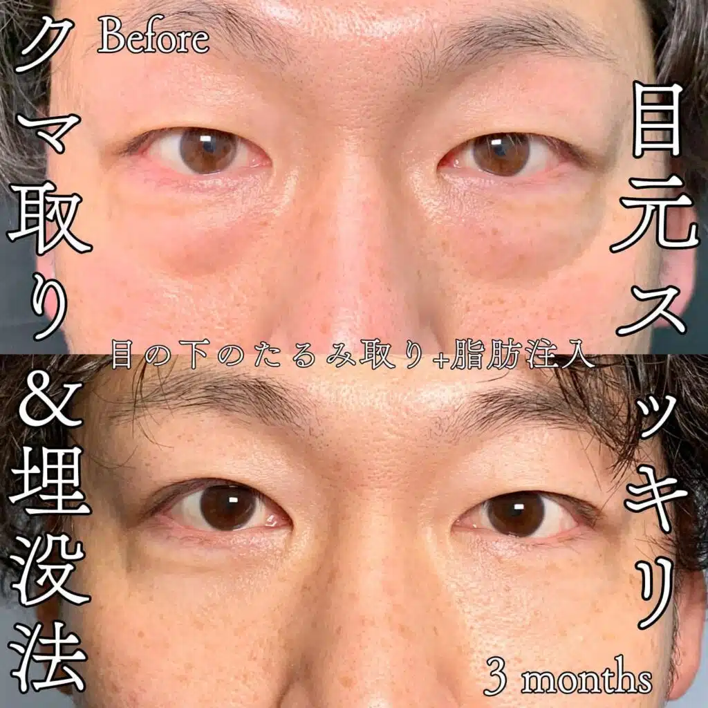 クマ取り 埋没