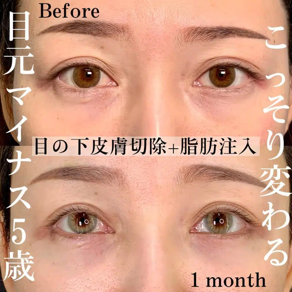 皮膚切除 脂肪注入