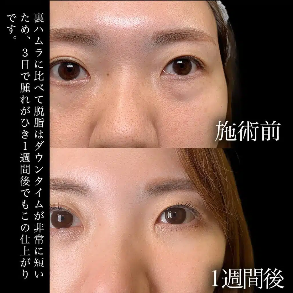 脱脂 ヒアルロン酸注入