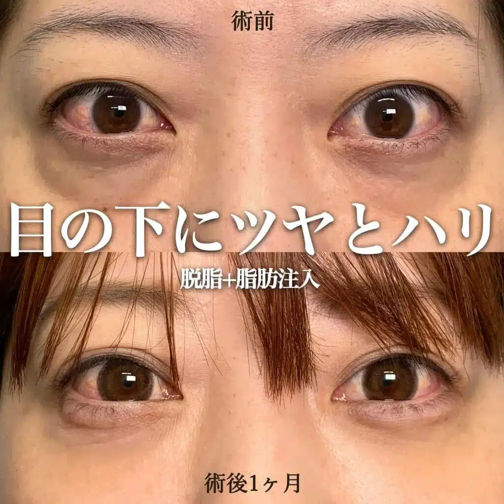 脱脂 脂肪注入