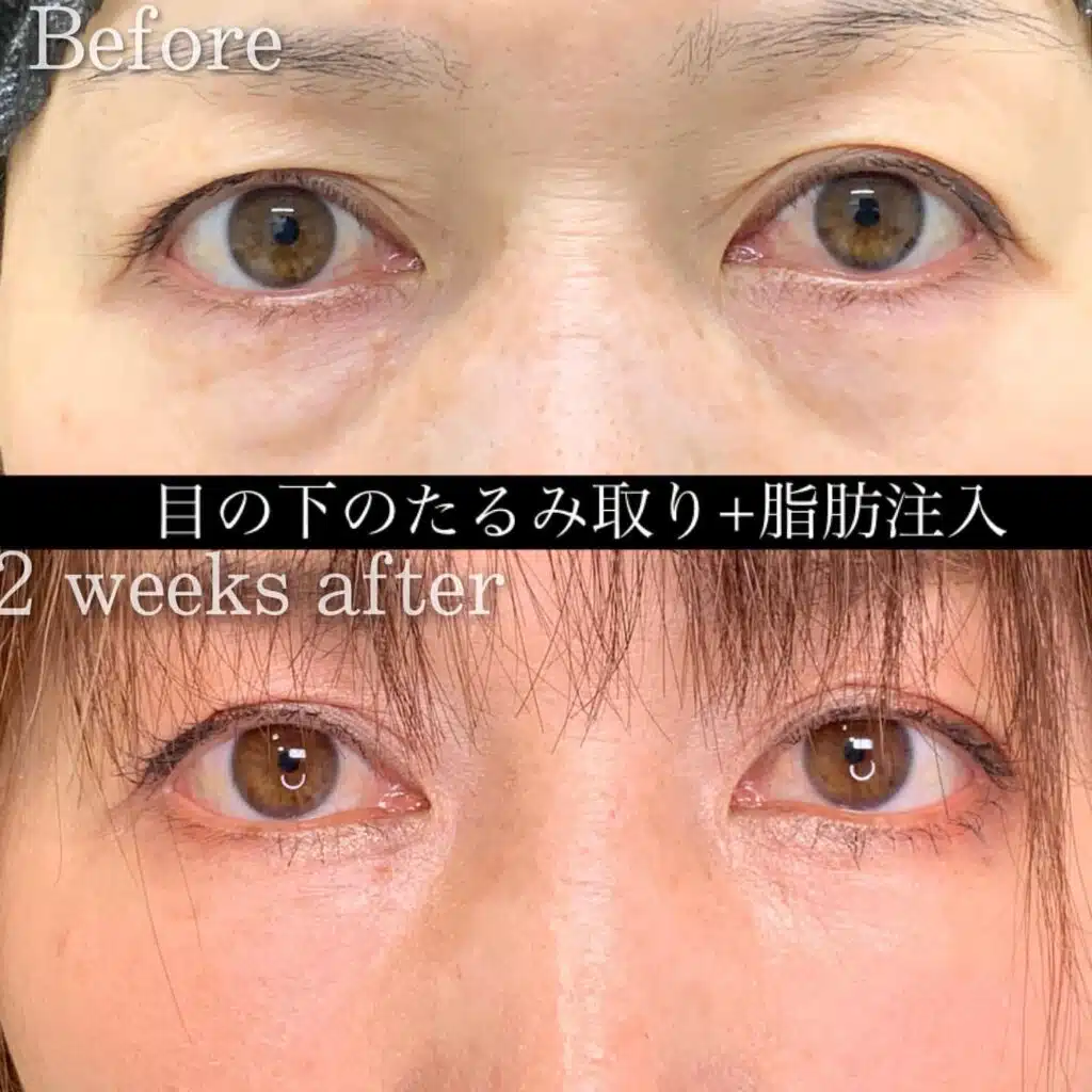 たるみ取り 脂肪注入