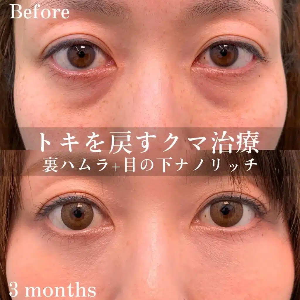 裏ハムラ ナノリッチ