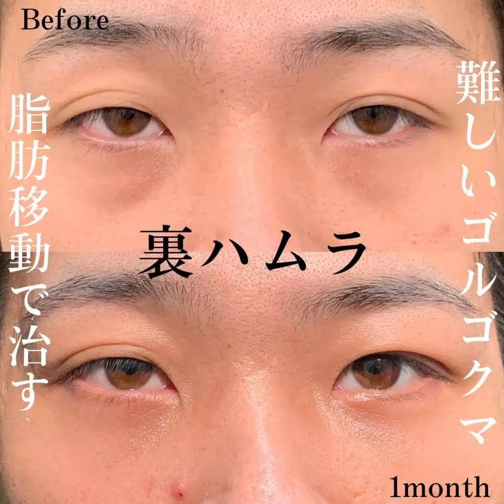 裏ハムラ