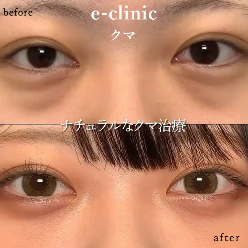 脂肪注入