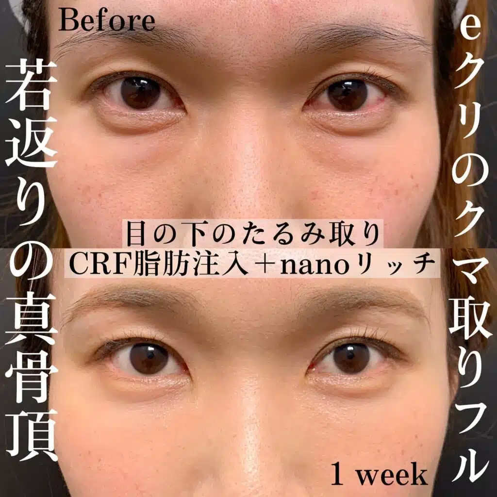 脂肪注入 ナノリッチ
