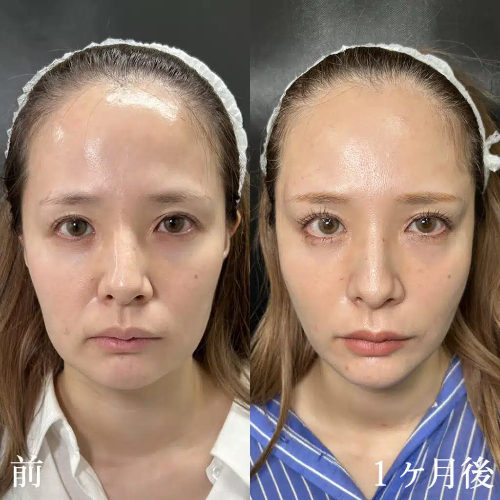 糸リフト