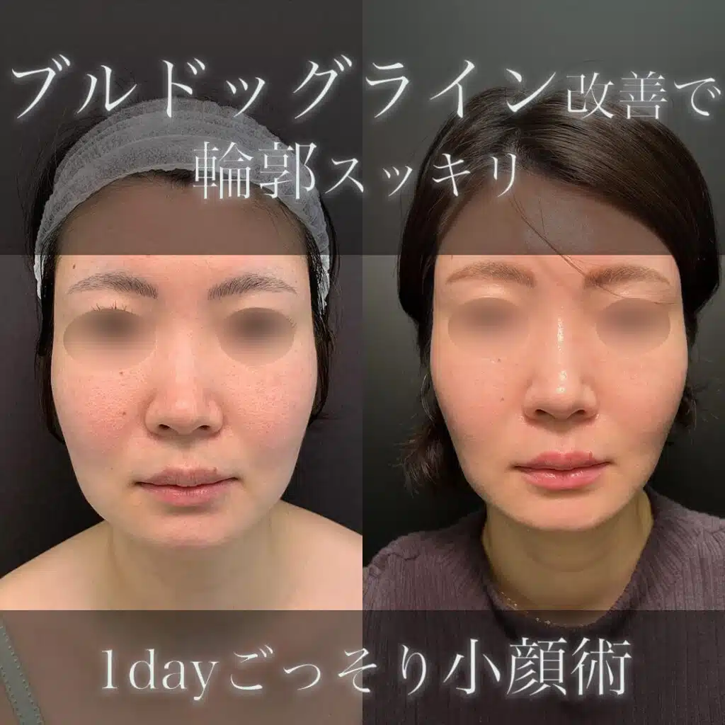 小顔