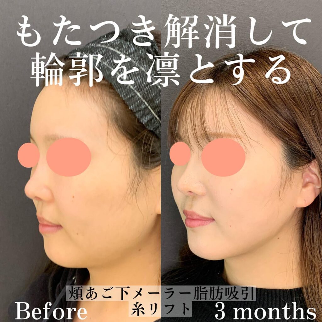 eclinic名古屋院の脂肪吸引症例写真