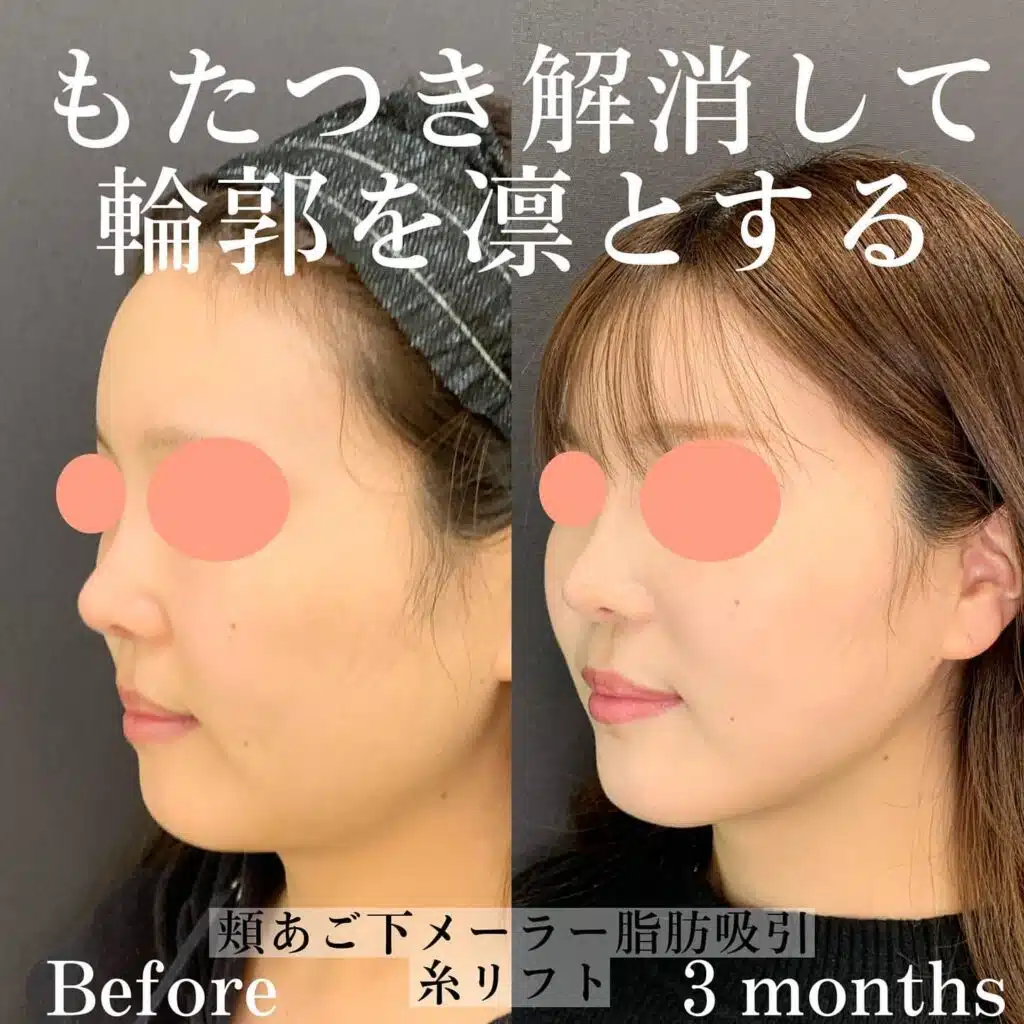 脂肪吸引 糸リフト
