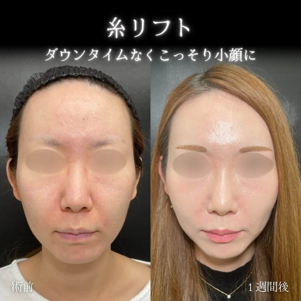 eclinic名古屋院の糸リフト症例写真