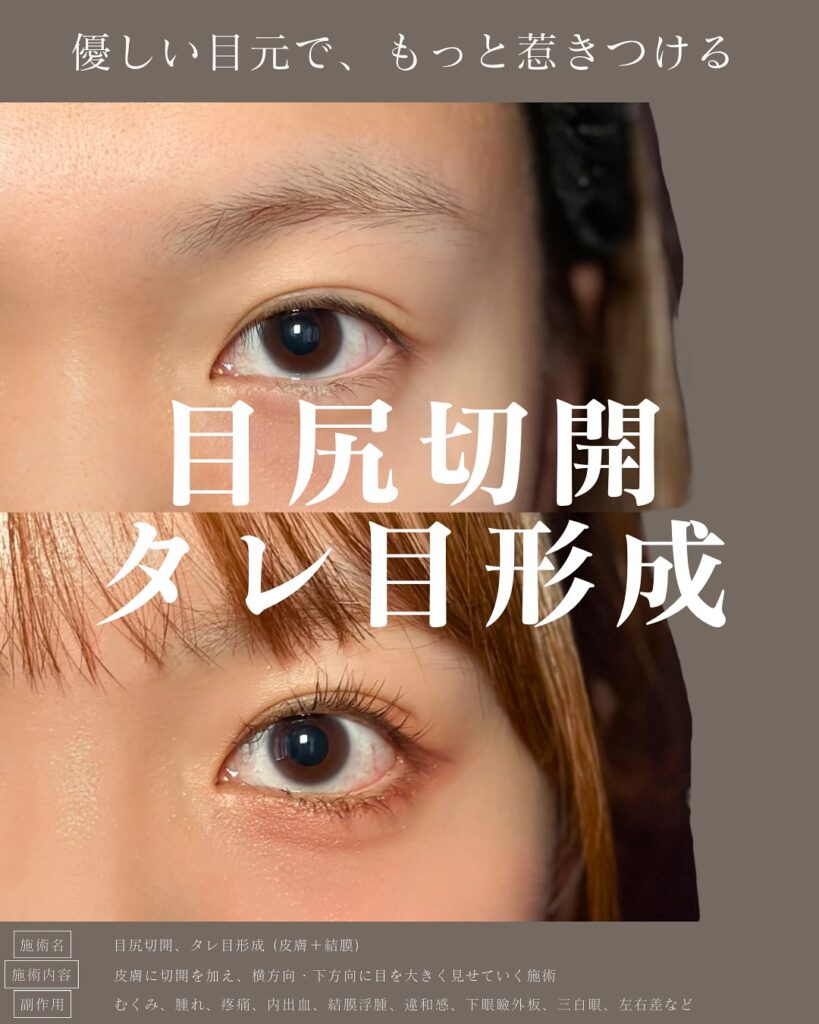 目尻切開とタレ目形成の症例写真