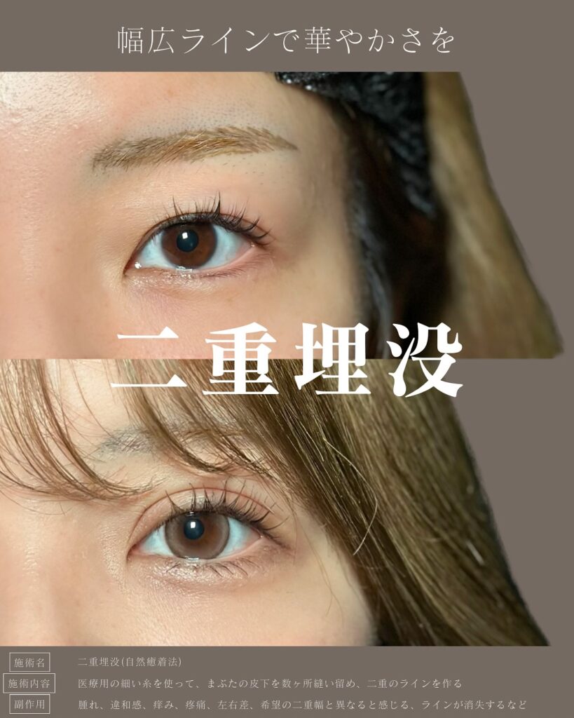 埋没法の症例写真 (10)