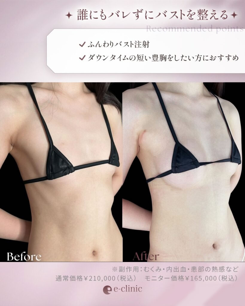 ふんわりバスト症例画像_1