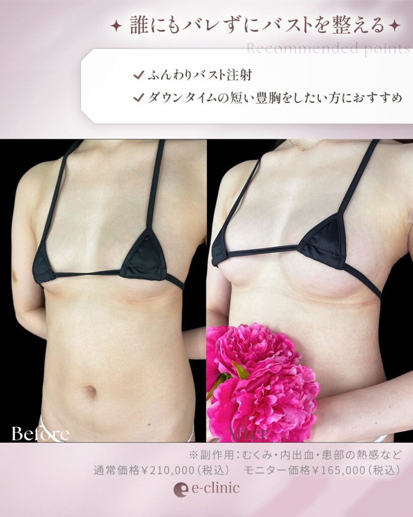 ふんわりバスト症例画像_2