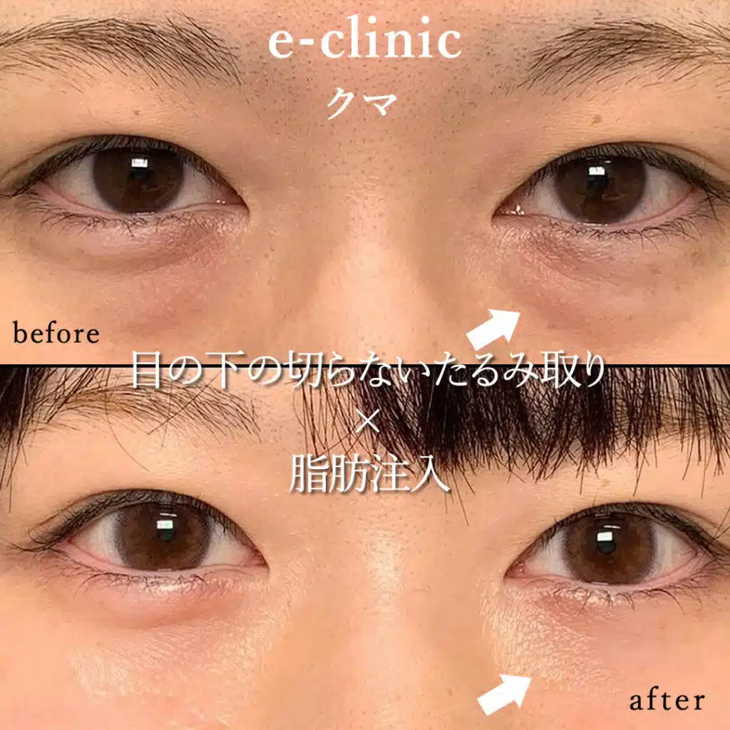 eclinic名古屋院の表ハムラの症例画像(1)