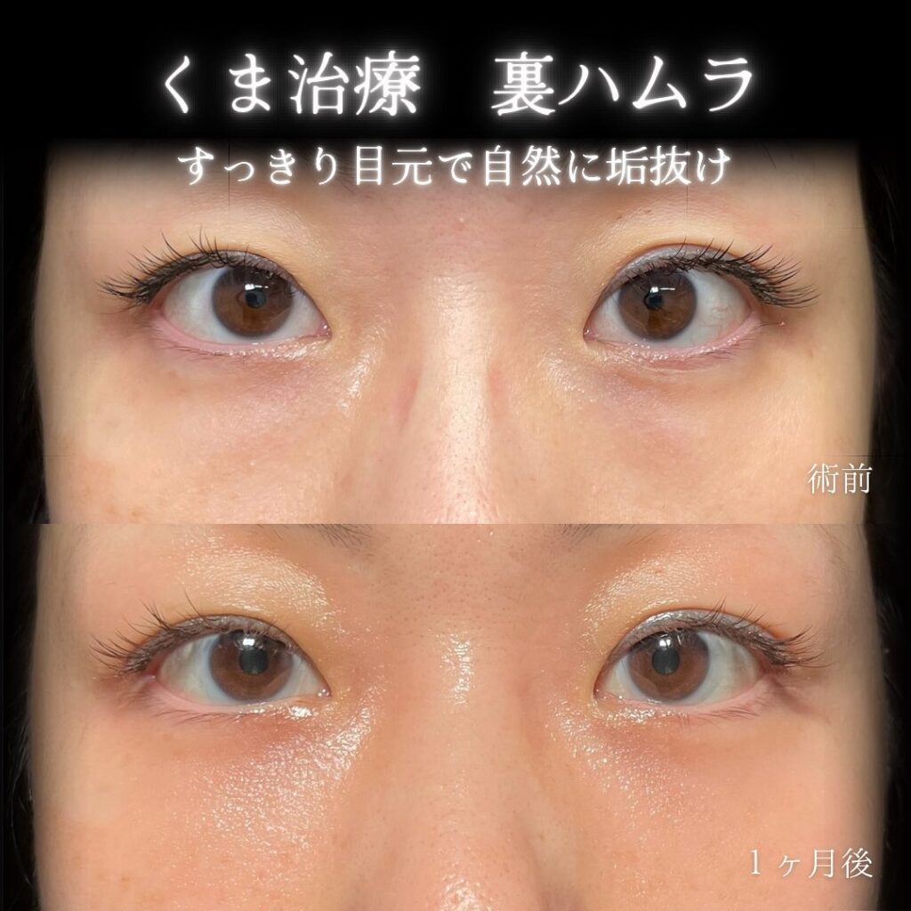 eclinic名古屋院の表ハムラの症例画像(4)
