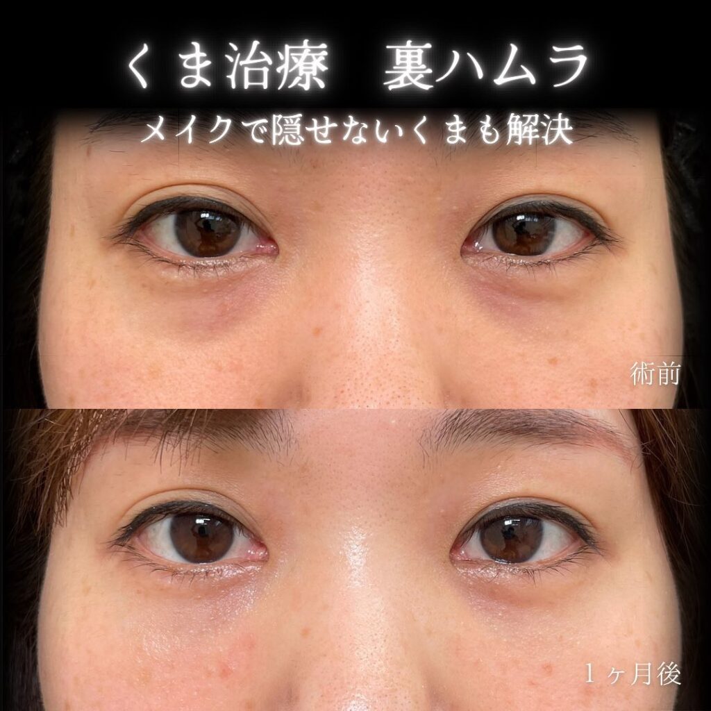 eclinic名古屋院の表ハムラの症例画像(5)