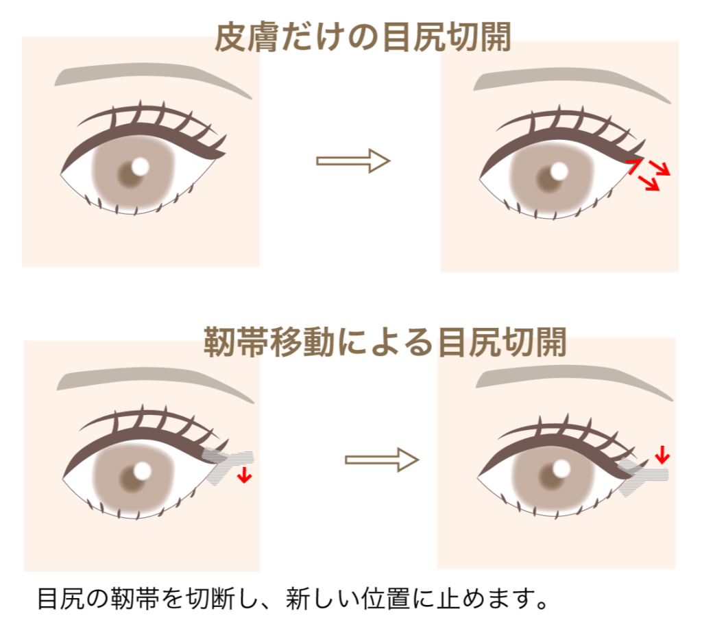 皮膚だけの目尻切開と靭帯移動による目尻切開の図解