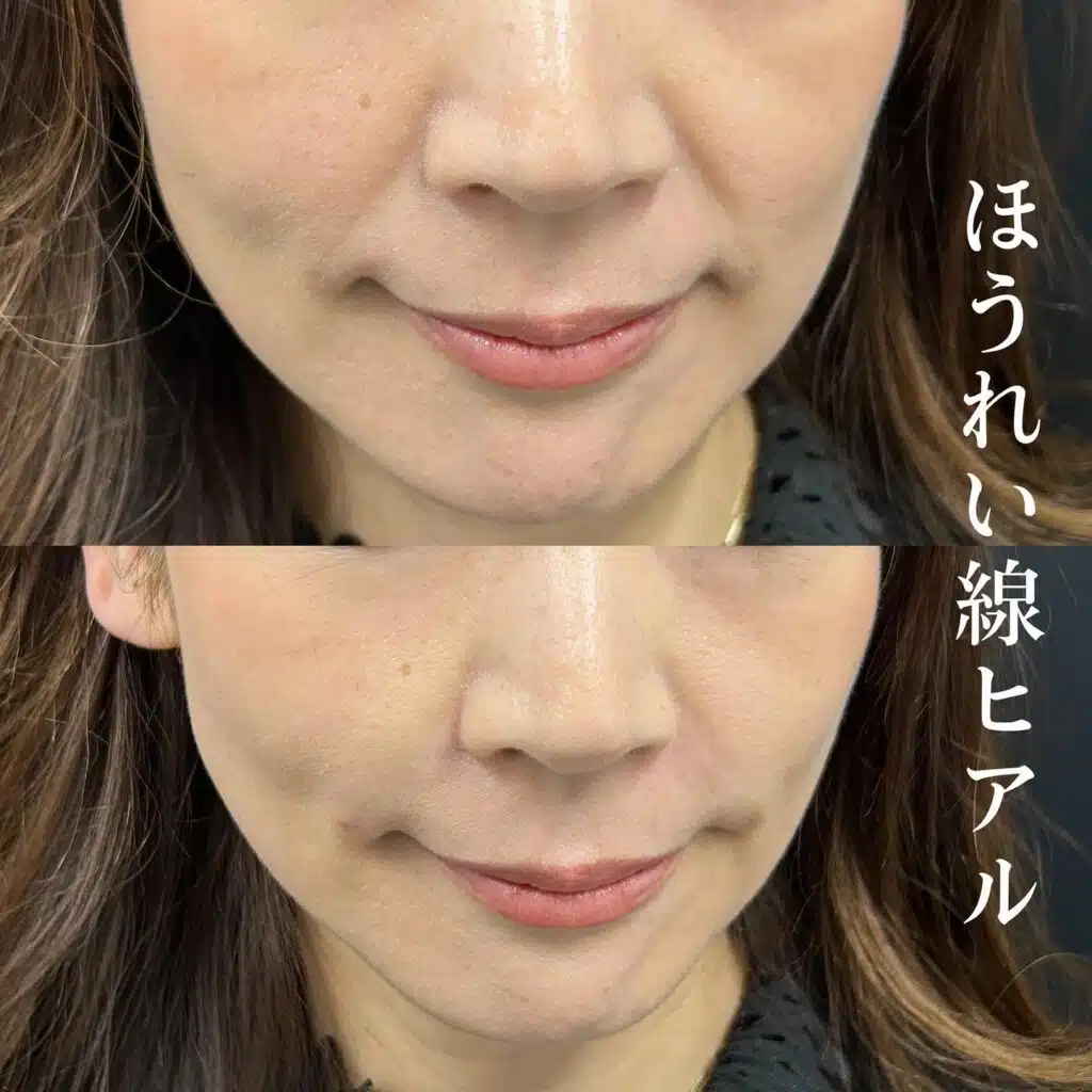 ほうれい線ヒアル　名古屋