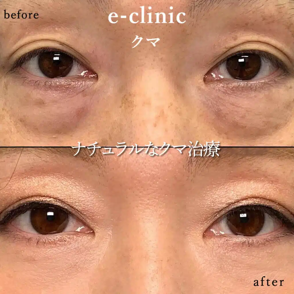 eclinic名古屋院の表ハムラの症例画像(3)