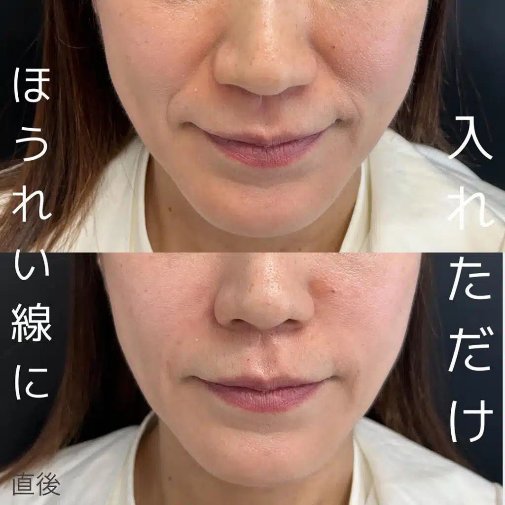 ほうれい線に入れただけ　名古屋　　