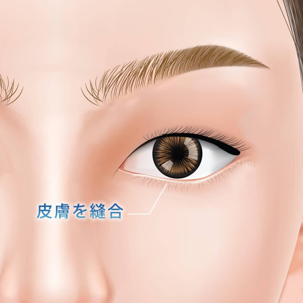 表ハムラの皮膚の縫合の図解