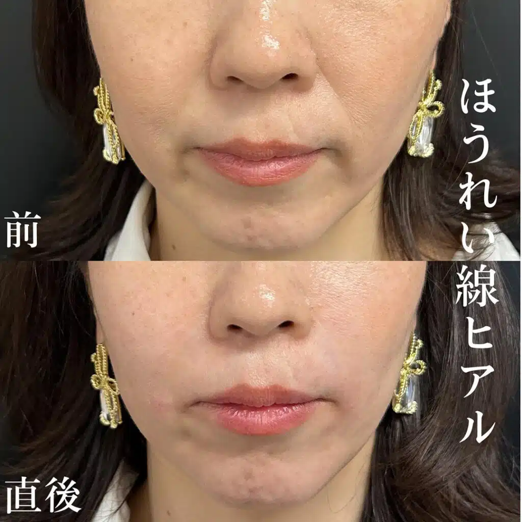 ほうれい線ヒアル　名古屋