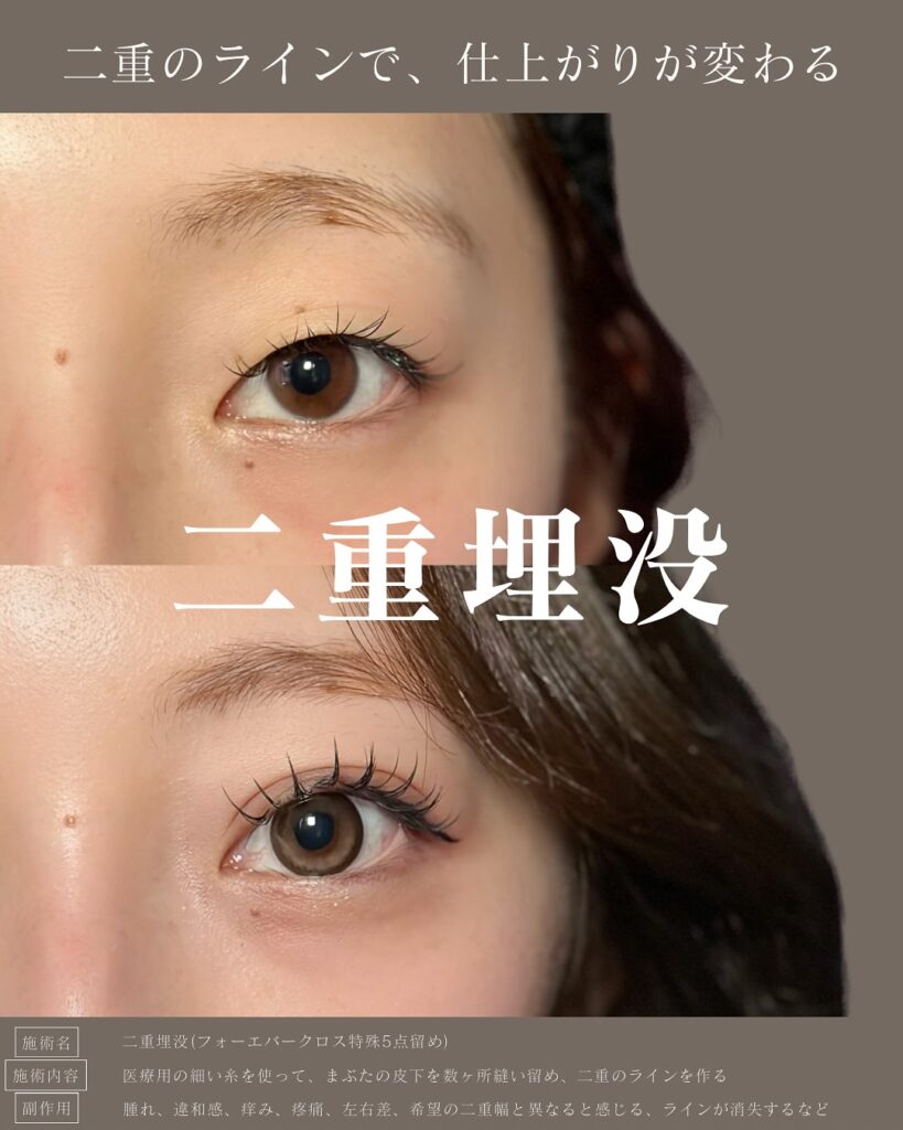 eクリニック名古屋院の二重整形・二重埋没法の症例写真（名医の服部健人医師が執刀）