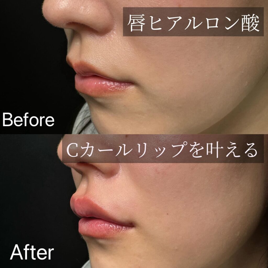 ヒアルロン酸　Cカールリップ