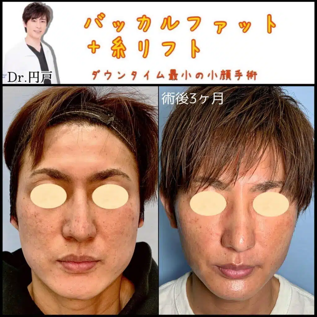 バッカルファット＋糸リフト　名古屋
