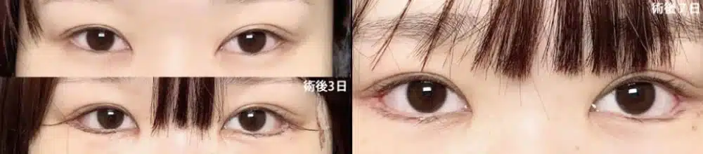 白目の露出を広げる　名古屋