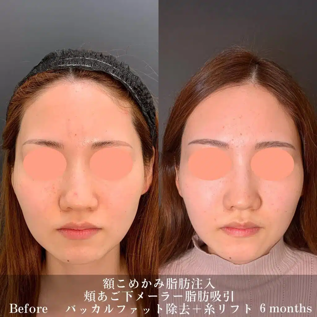 額こめかみ脂肪注入 頬あご下メーラー脂肪注入 バッカルファット+糸リフト 名古屋