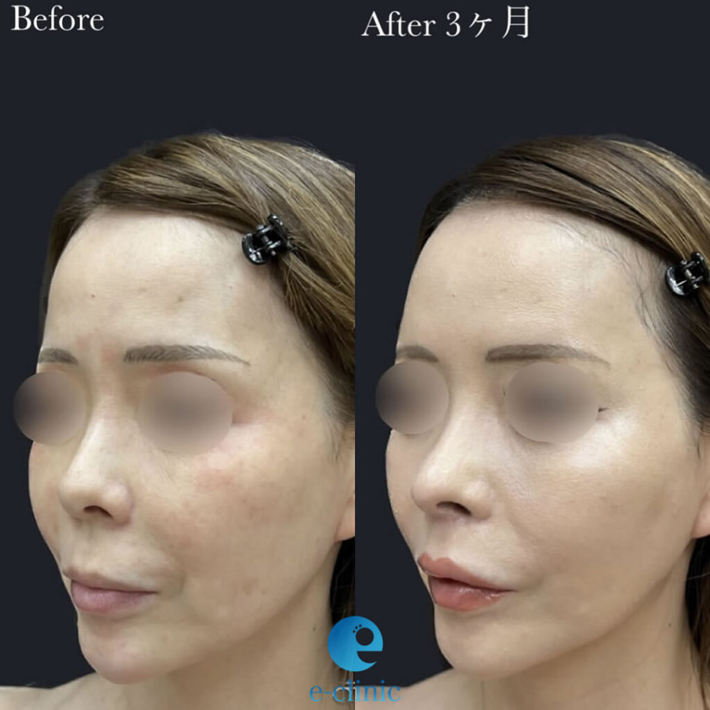 肋軟骨を使用した鼻の修正手術とリップリフトの症例写真