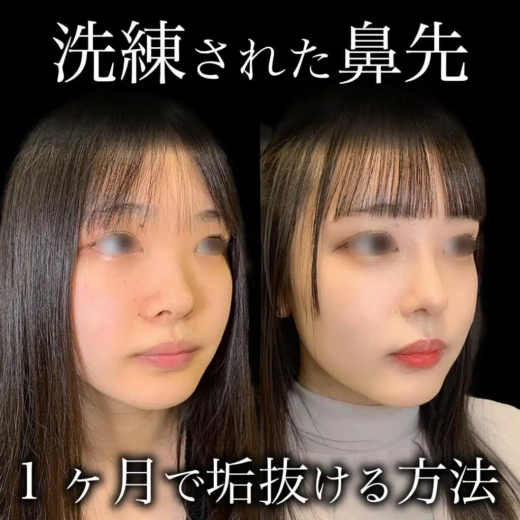 鼻の耳介軟骨移植 名古屋