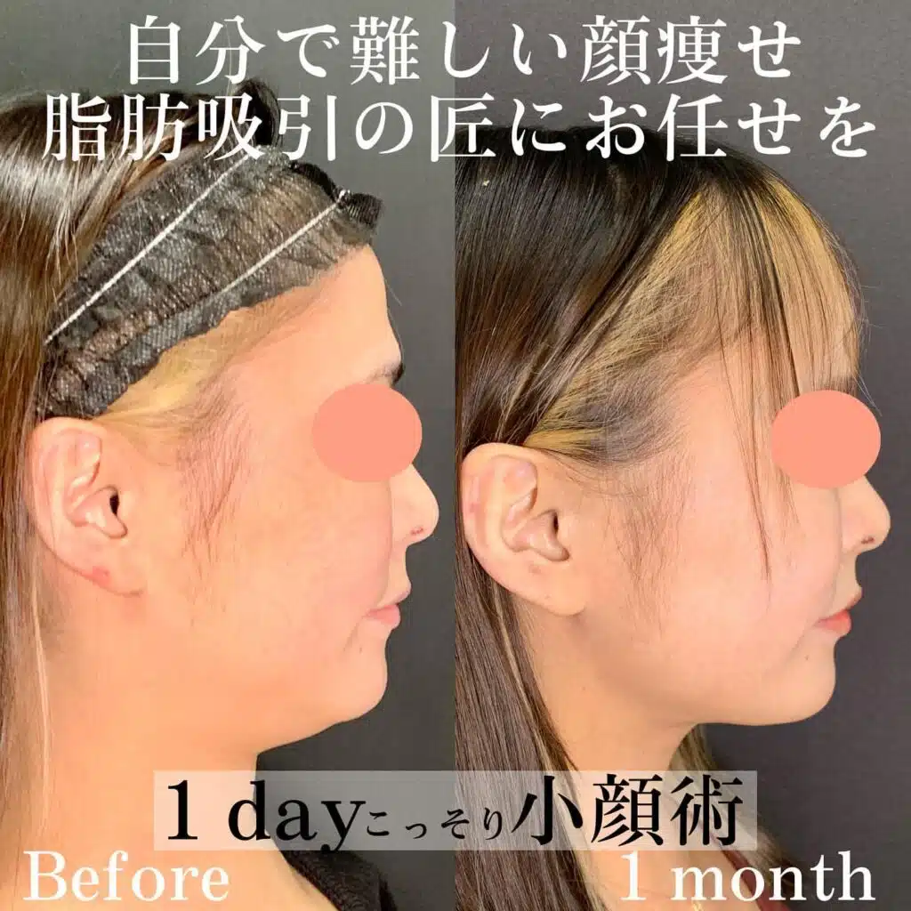 小顔脂肪吸引 名古屋