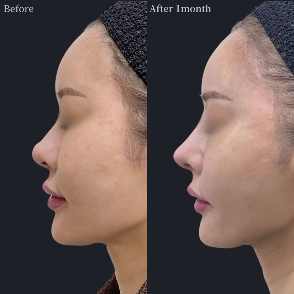 鼻フルの症例写真