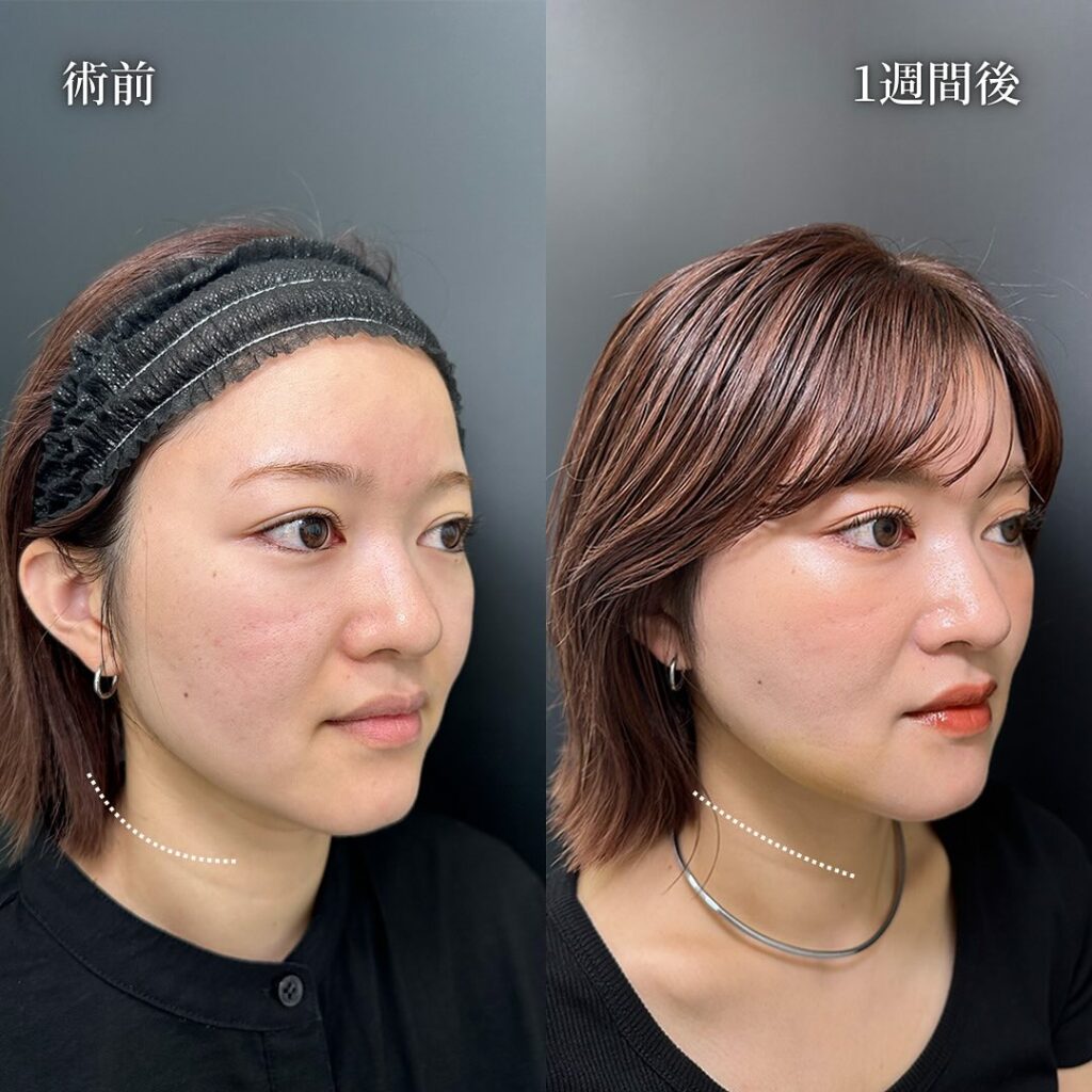 糸リフト②