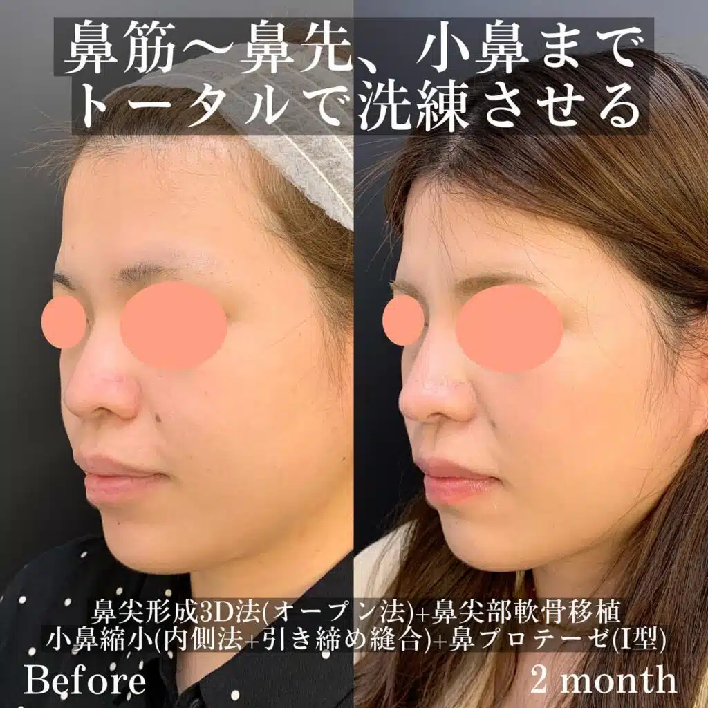 鼻尖形成3D法(オープン法)+鼻尖部軟骨移植+小鼻縮小(内側法+引き締め縫合)+鼻プロテーゼ(Ⅰ型) 名古屋
