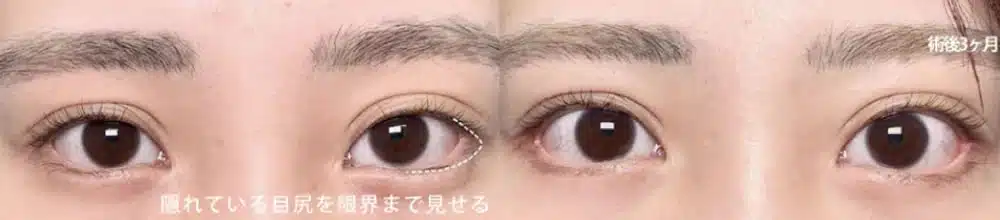 目尻側の白目の露出を増やす　名古屋