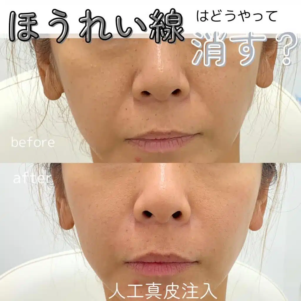 人工真皮注入　名古屋