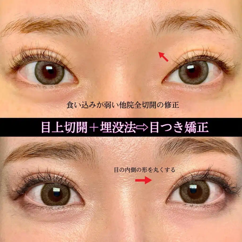 目上切開+埋没法　名古屋