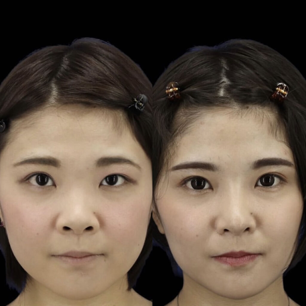 耳軟骨を使用した鼻フル整形と全切開と小鼻縮小の正面の症例写真