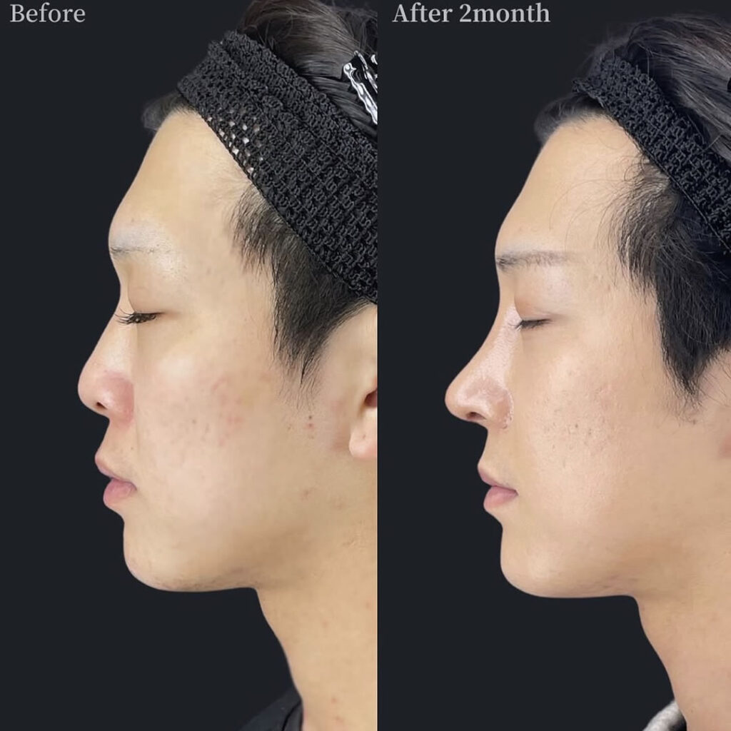 メンズの鼻フルの症例写真