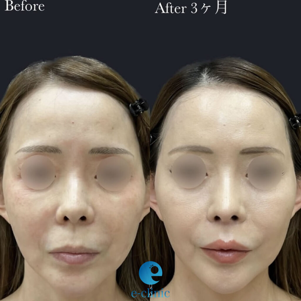 肋軟骨を使用した鼻の修正手術とリップリフトの正面の症例写真